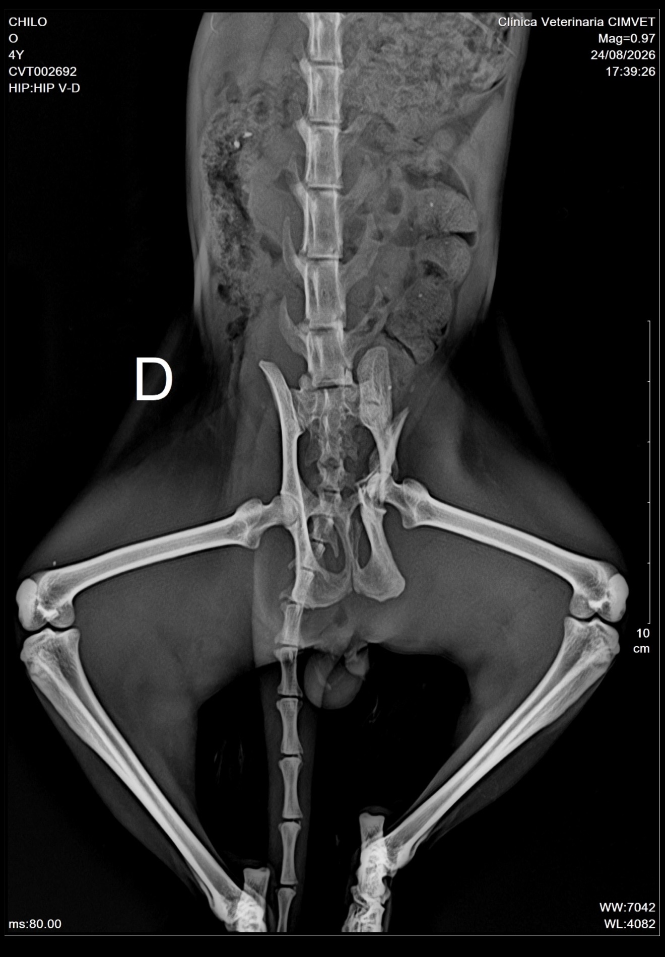 X-ray showing Chilo's fractured pelvis