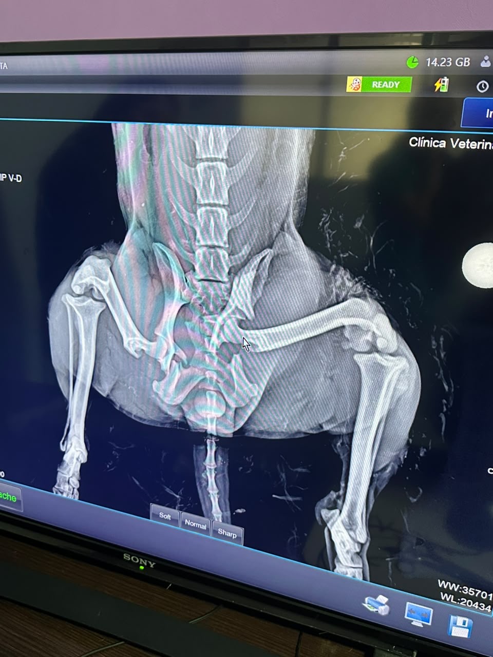 X-ray showing Muñeca's fractures